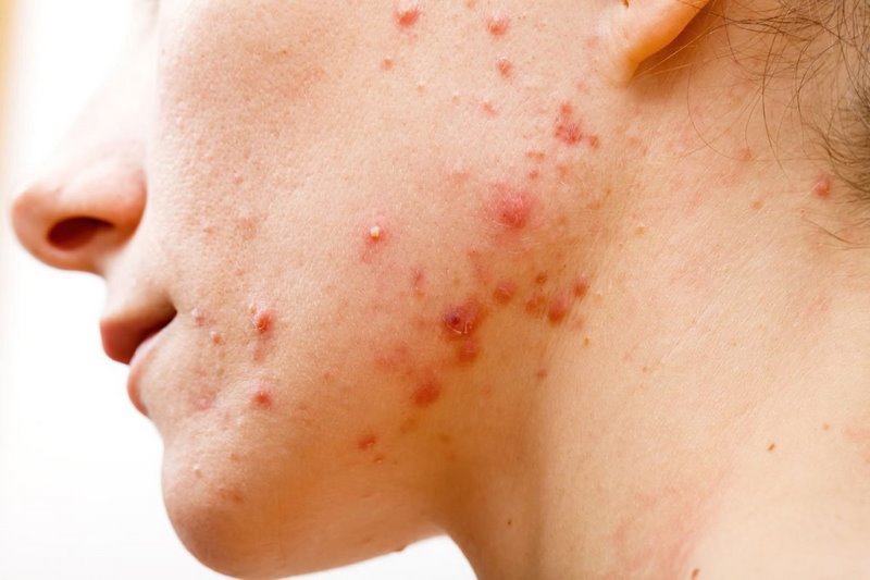 Không được sử dụng mặt nạ đất sét khi da đang bị mụn, viêm nhiễm