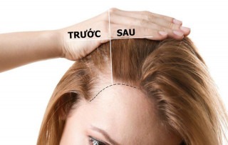 Tham khảo 3 cách để tóc mọc nhanh hiệu quả và an toàn