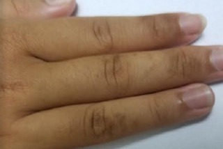 Da ngón tay bị thâm đen cảnh báo gì đến sức khỏe của bạn?