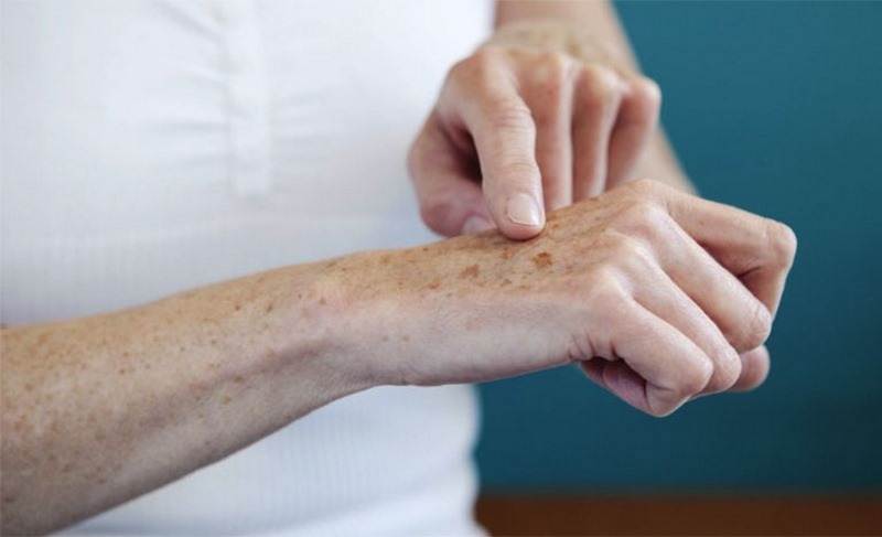 Nổi vết thâm trên da tay có thể so kích ứng mỹ phẩm chăm sóc da