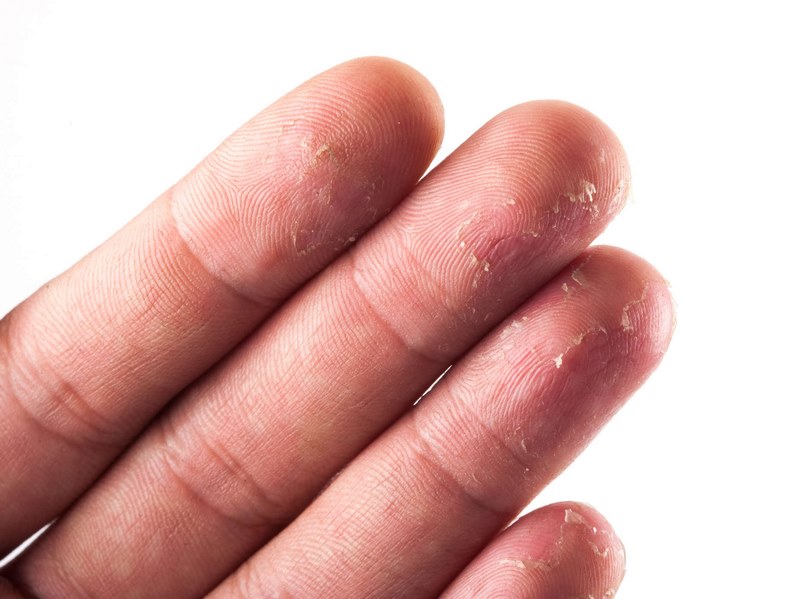 Da tay sần sùi và không mịn màng do nhiều nguyên nhân gây nên