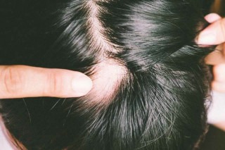 Rụng tóc từng mảng là bệnh gì và những thông tin liên quan
