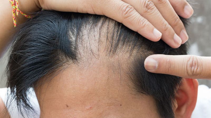 Tóc rụng thành từng mảng khi nào được coi là bệnh lý